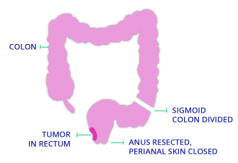 Abdominoperineal Resection Diagram for TAMIS Surgery