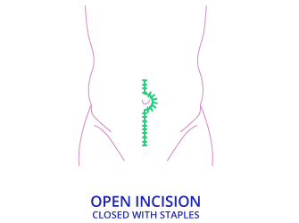 Incision Diagram for TAMIS Surgery Options