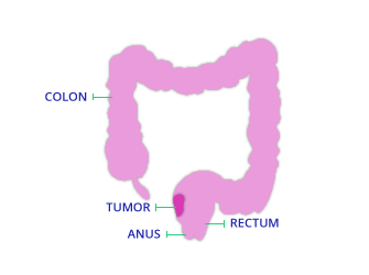 Local Excision Diagram for TAMIS Surgery