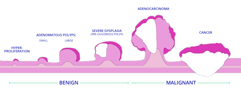 Rectal Cancer Staging Diagram of Benign and Malignant Stages for TAMIS Surgery